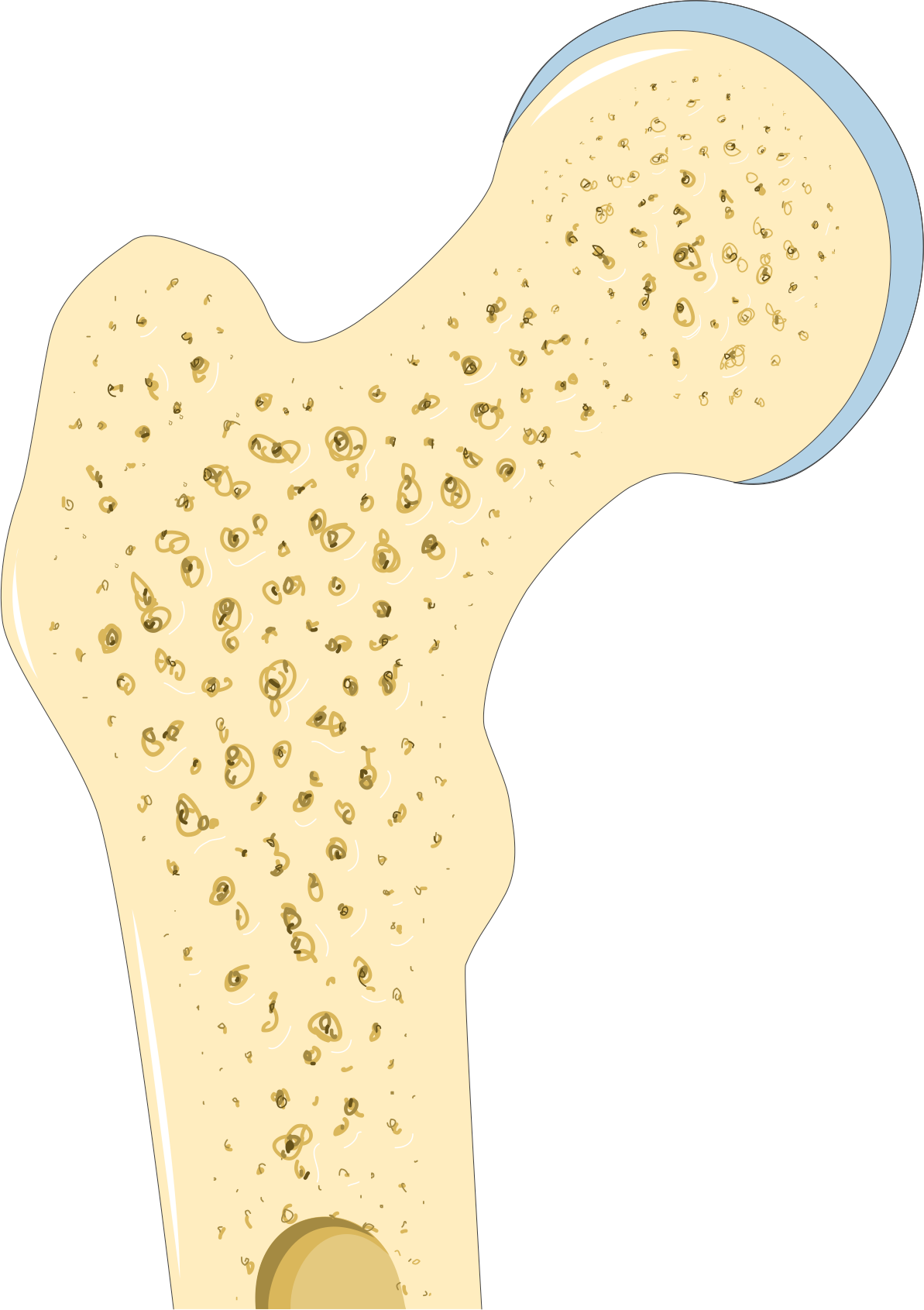 Understanding Osteoporosis